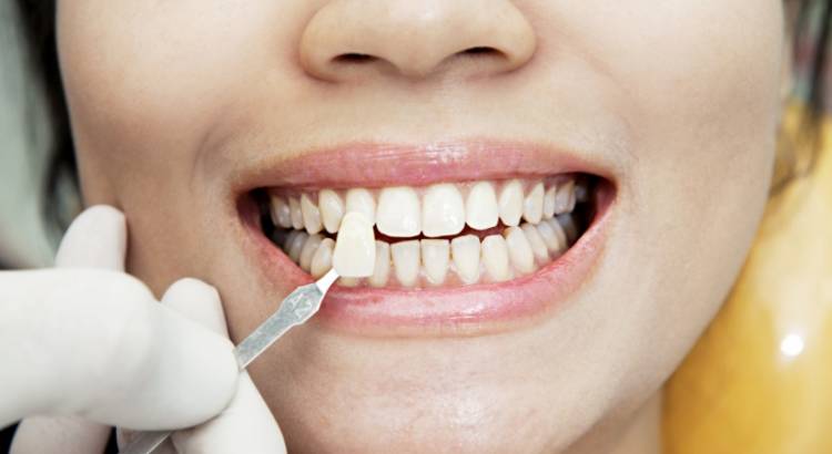 Ո՞ր մթերքներն են փչացնում ատամների տեսքը 