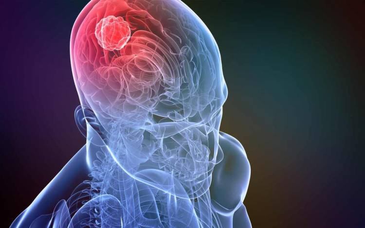 Ուռուցքաբանը նշել է գլխուղեղի քաղցկեղի սկզբնական ախտանիշները